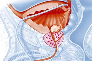 Өнөкөт простатит - бул простата безинин сезгенүү оорусу