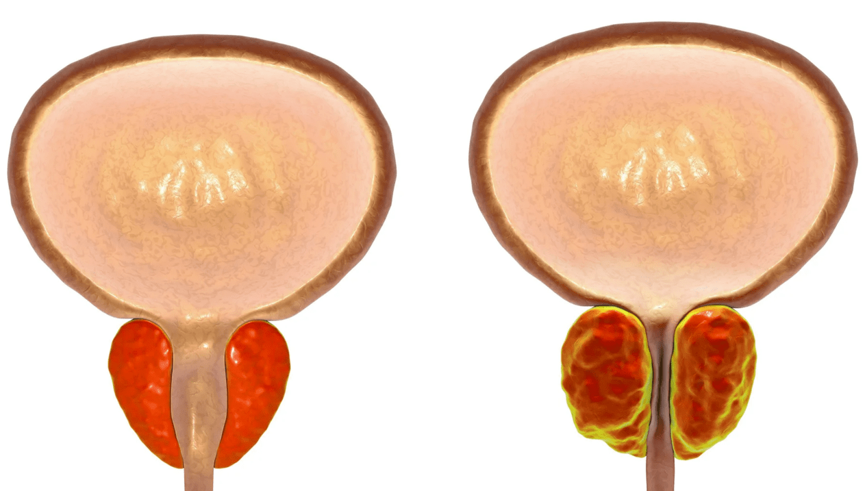Простатит деген эмне
