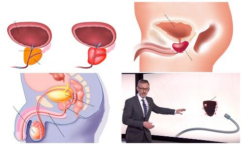 дени сак жана оорулуу простата